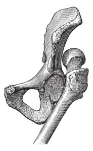 Dislocation of the hip, vintage engraving.
